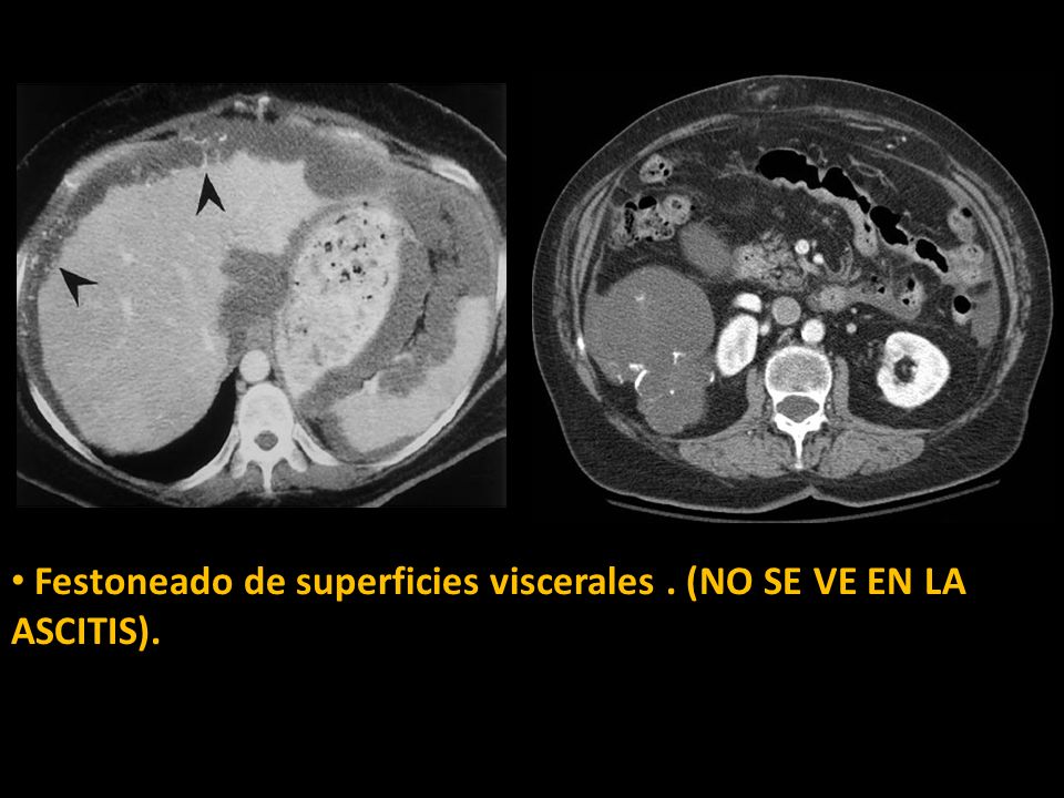 Festoneado de superficies viscerales . (NO SE VE EN LA ASCITIS).