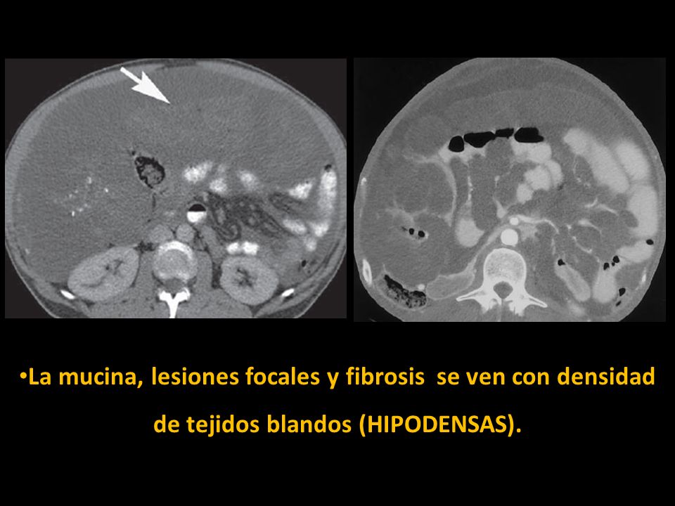 La mucina, lesiones focales y fibrosis se ven con densidad de tejidos blandos (HIPODENSAS).