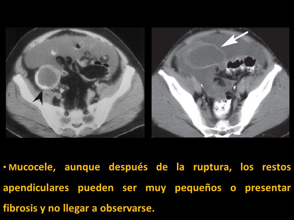 Mucocele, aunque después de la ruptura, los restos apendiculares pueden ser muy pequeños o presentar fibrosis y no llegar a observarse.