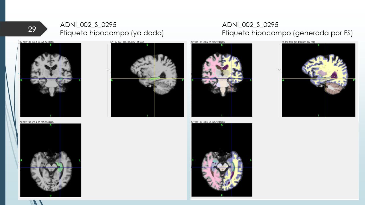 ADNI_002_S_0295 Etiqueta hipocampo (ya dada) ADNI_002_S_0295 Etiqueta hipocampo (generada por FS)