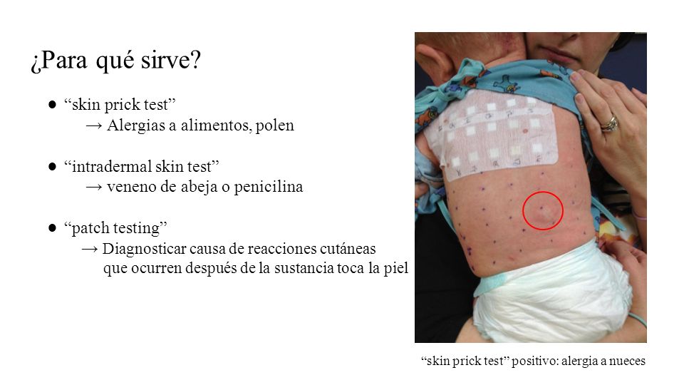 ¿Para qué sirve skin prick test → Alergias a alimentos, polen