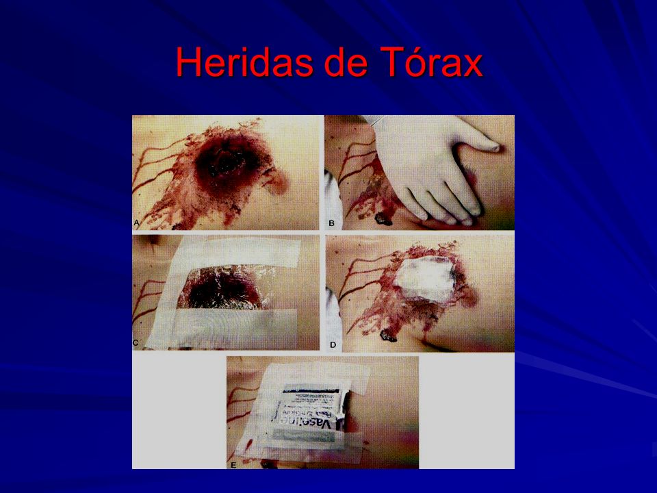Heridas de Tórax