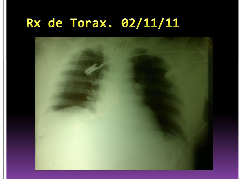 Rx de Torax. 02/11/11