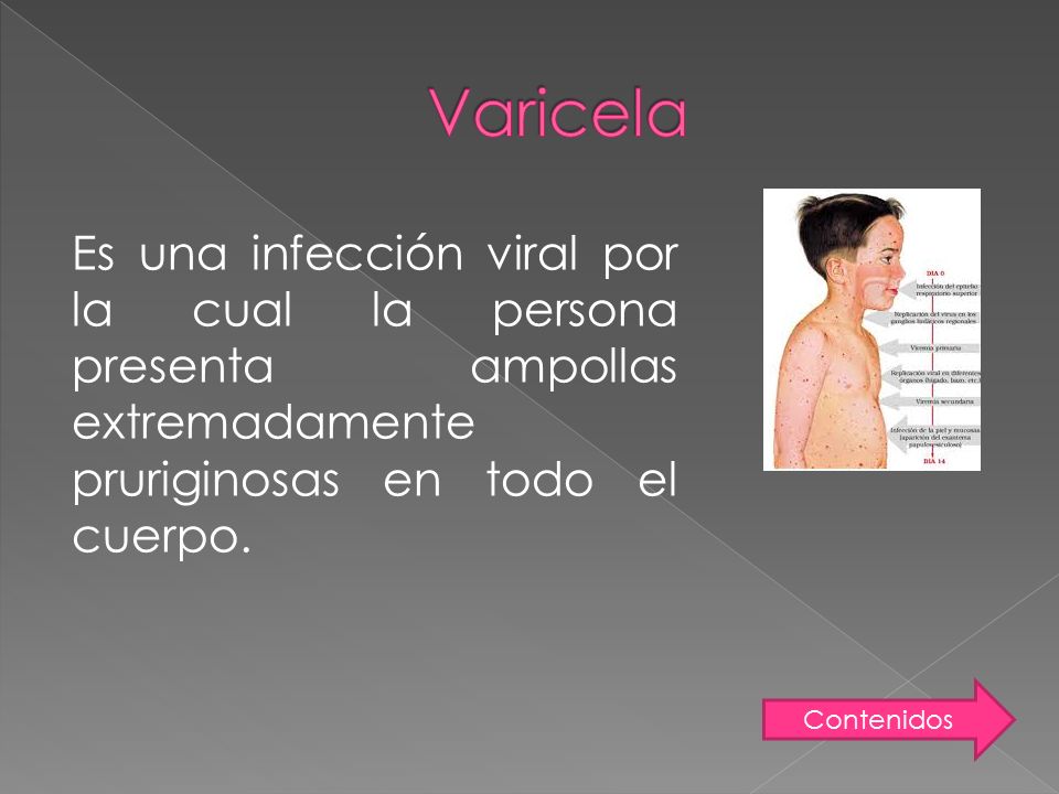 Varicela Es una infección viral por la cual la persona presenta ampollas extremadamente pruriginosas en todo el cuerpo.