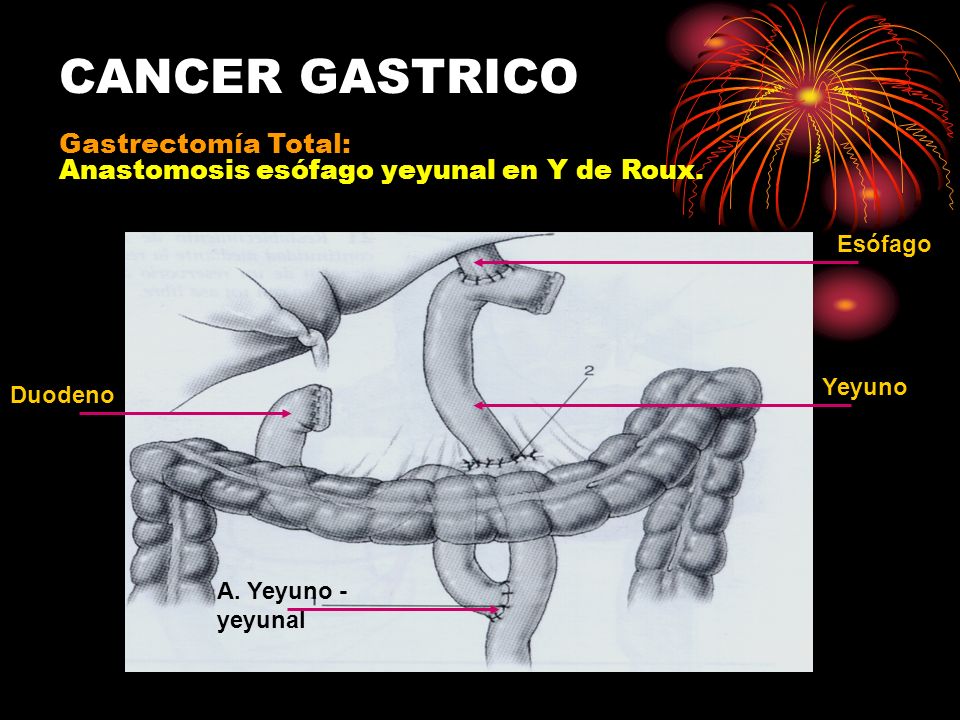 CANCER GASTRICO Gastrectomía Total: Anastomosis esófago yeyunal en Y de Roux. Esófago. Yeyuno. Duodeno.