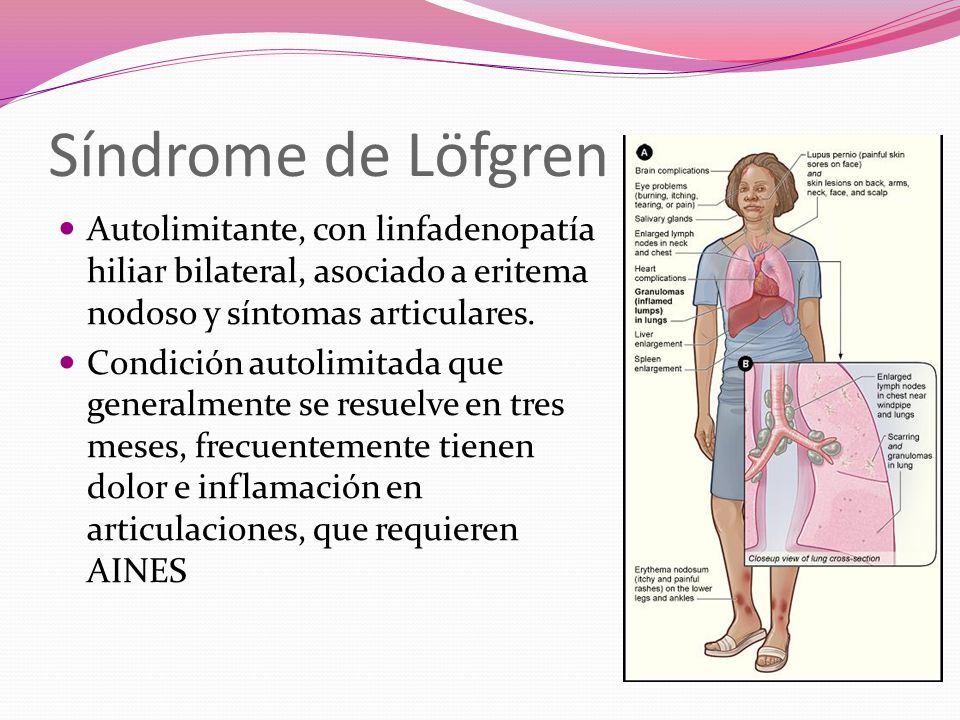 Síndrome de Löfgren Autolimitante, con linfadenopatía hiliar bilateral, asociado a eritema nodoso y síntomas articulares.