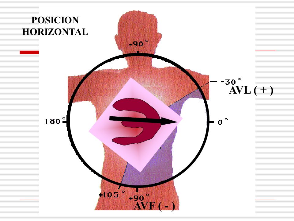 POSICION HORIZONTAL AVL ( + ) AVF ( - )