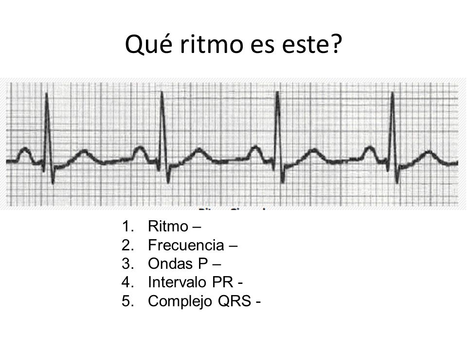 Qué ritmo es este Ritmo – Frecuencia – Ondas P – Intervalo PR -