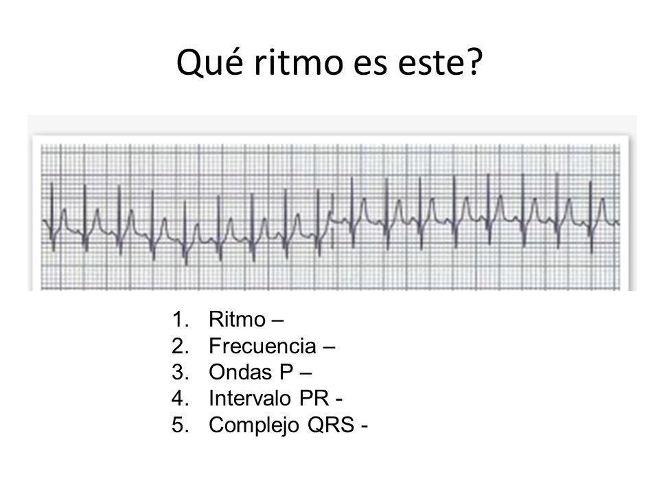 Qué ritmo es este Ritmo – Frecuencia – Ondas P – Intervalo PR -