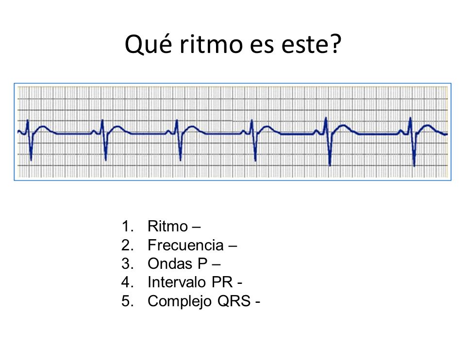 Qué ritmo es este Ritmo – Frecuencia – Ondas P – Intervalo PR -