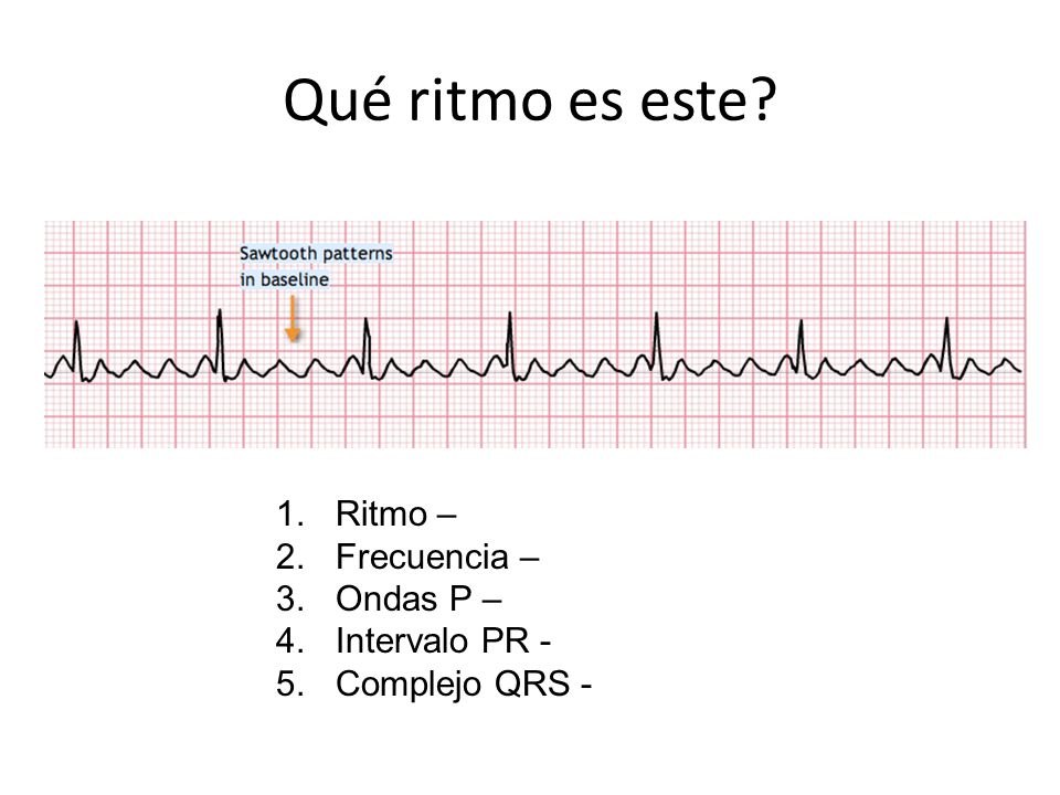 Qué ritmo es este Ritmo – Frecuencia – Ondas P – Intervalo PR -