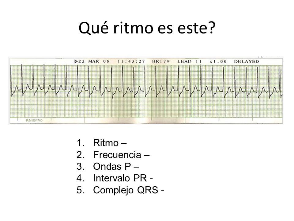 Qué ritmo es este Ritmo – Frecuencia – Ondas P – Intervalo PR -