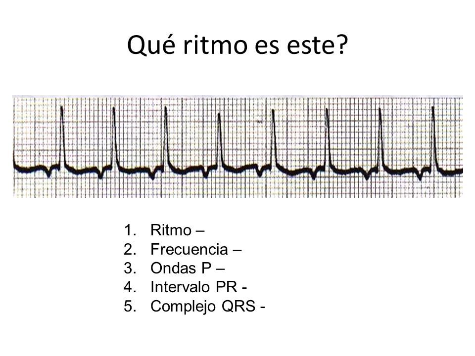 Qué ritmo es este Ritmo – Frecuencia – Ondas P – Intervalo PR -