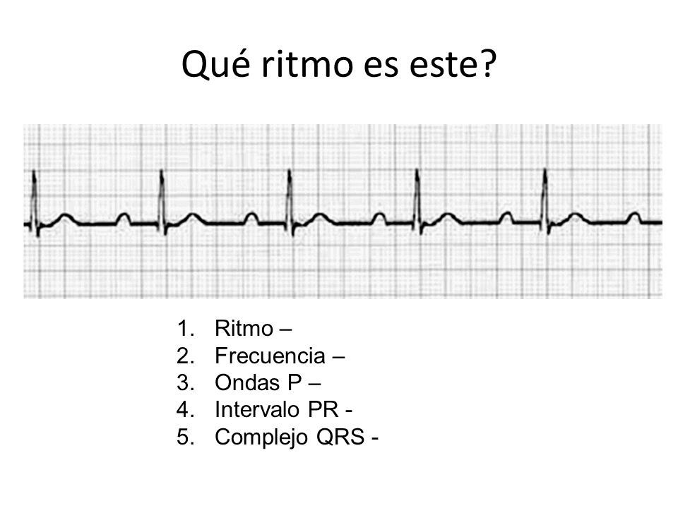 Qué ritmo es este Ritmo – Frecuencia – Ondas P – Intervalo PR -