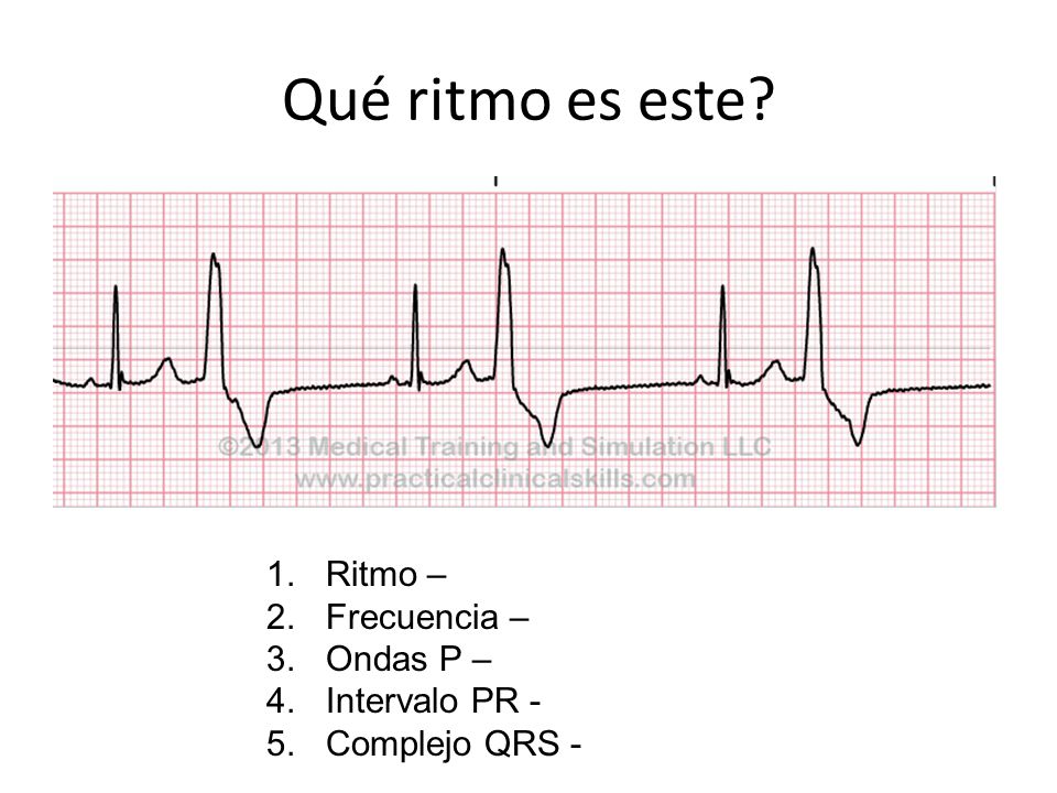 Qué ritmo es este Ritmo – Frecuencia – Ondas P – Intervalo PR -