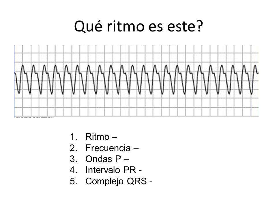 Qué ritmo es este Ritmo – Frecuencia – Ondas P – Intervalo PR -