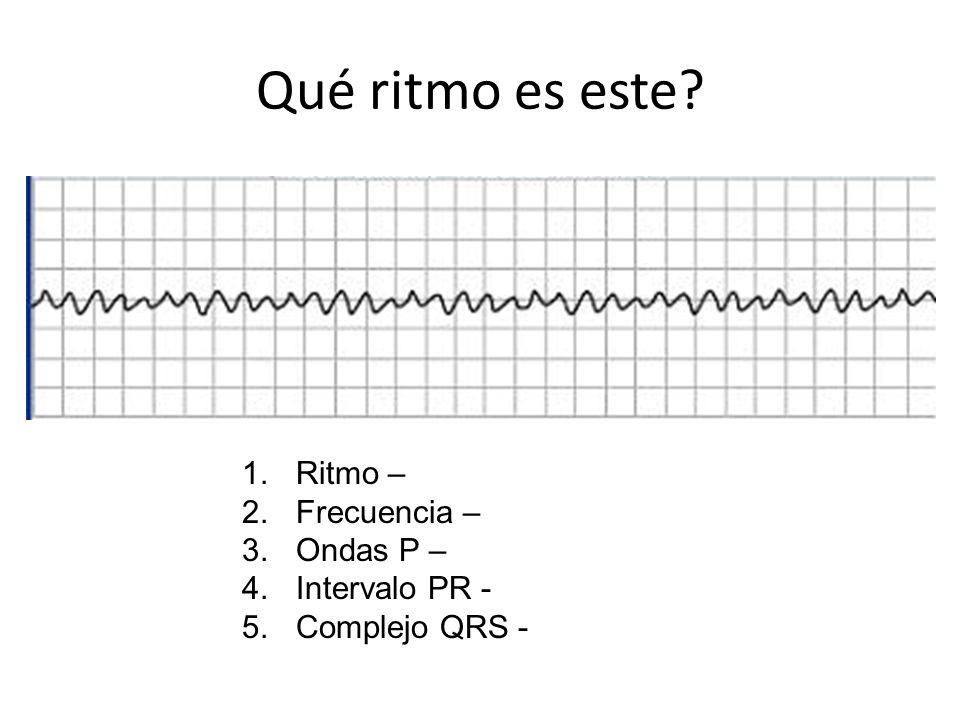 Qué ritmo es este Ritmo – Frecuencia – Ondas P – Intervalo PR -