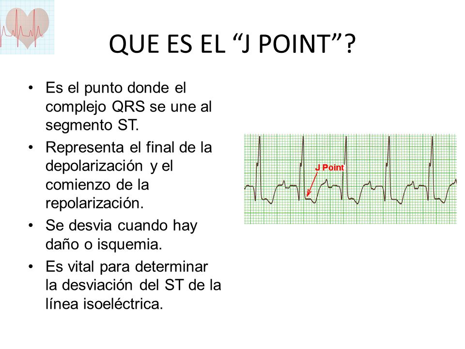 QUE ES EL J POINT Es el punto donde el complejo QRS se une al segmento ST.