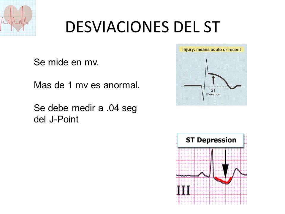 DESVIACIONES DEL ST Se mide en mv. Mas de 1 mv es anormal.