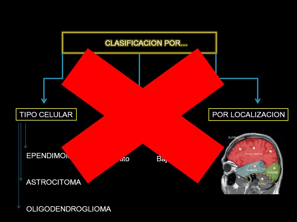 CLASIFICACION POR… EPENDIMOMA. ASTROCITOMA. OLIGODENDROGLIOMA. POR GRADO. POR LOCALIZACION. Alto Bajo.