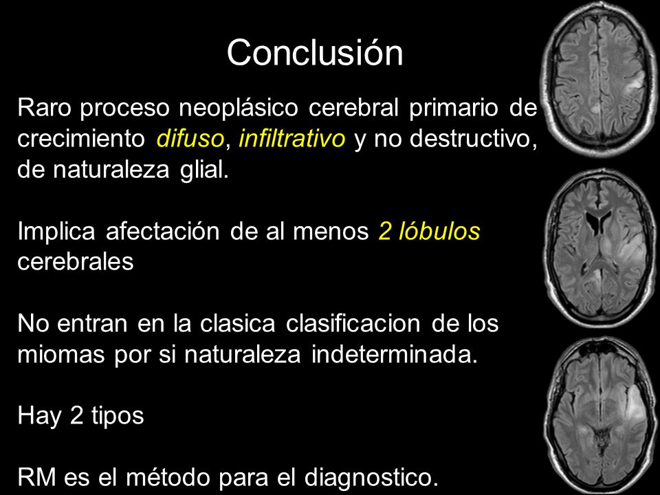 Conclusión Raro proceso neoplásico cerebral primario de crecimiento difuso, infiltrativo y no destructivo, de naturaleza glial.