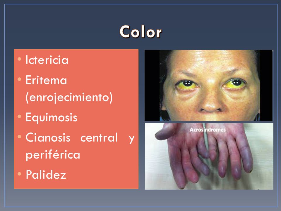 Color Ictericia Eritema (enrojecimiento) Equimosis