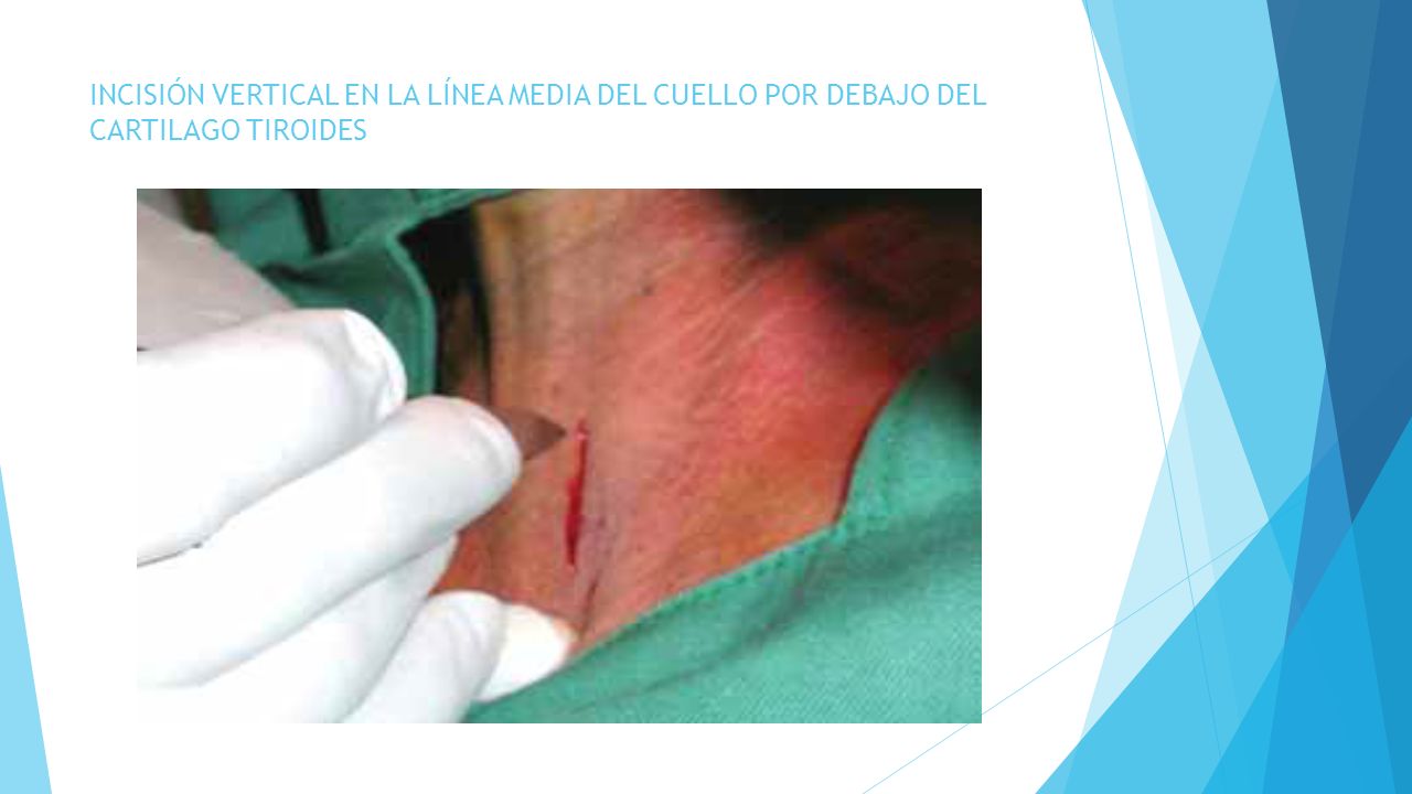 INCISIÓN VERTICAL EN LA LÍNEA MEDIA DEL CUELLO POR DEBAJO DEL CARTILAGO TIROIDES