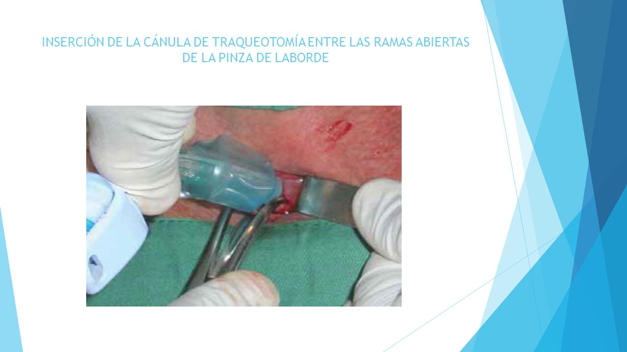 INSERCIÓN DE LA CÁNULA DE TRAQUEOTOMÍA ENTRE LAS RAMAS ABIERTAS DE LA PINZA DE LABORDE