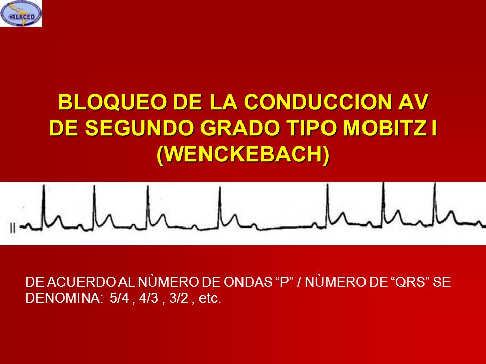 BLOQUEO DE LA CONDUCCION AV DE SEGUNDO GRADO TIPO MOBITZ I (WENCKEBACH)