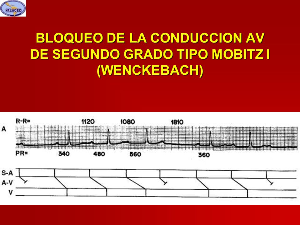 BLOQUEO DE LA CONDUCCION AV DE SEGUNDO GRADO TIPO MOBITZ I (WENCKEBACH)