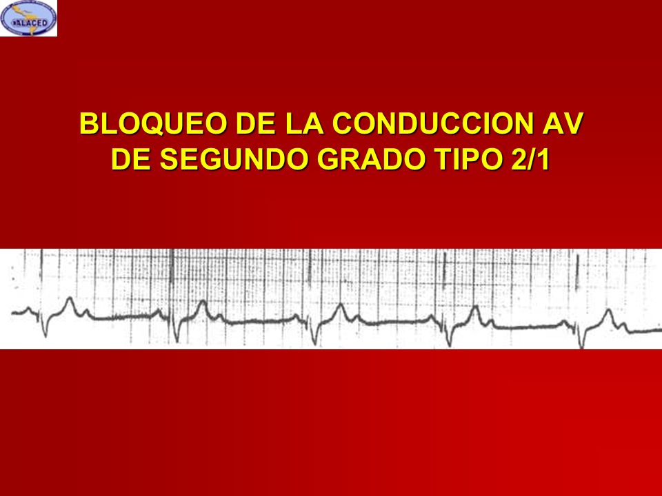 BLOQUEO DE LA CONDUCCION AV DE SEGUNDO GRADO TIPO 2/1