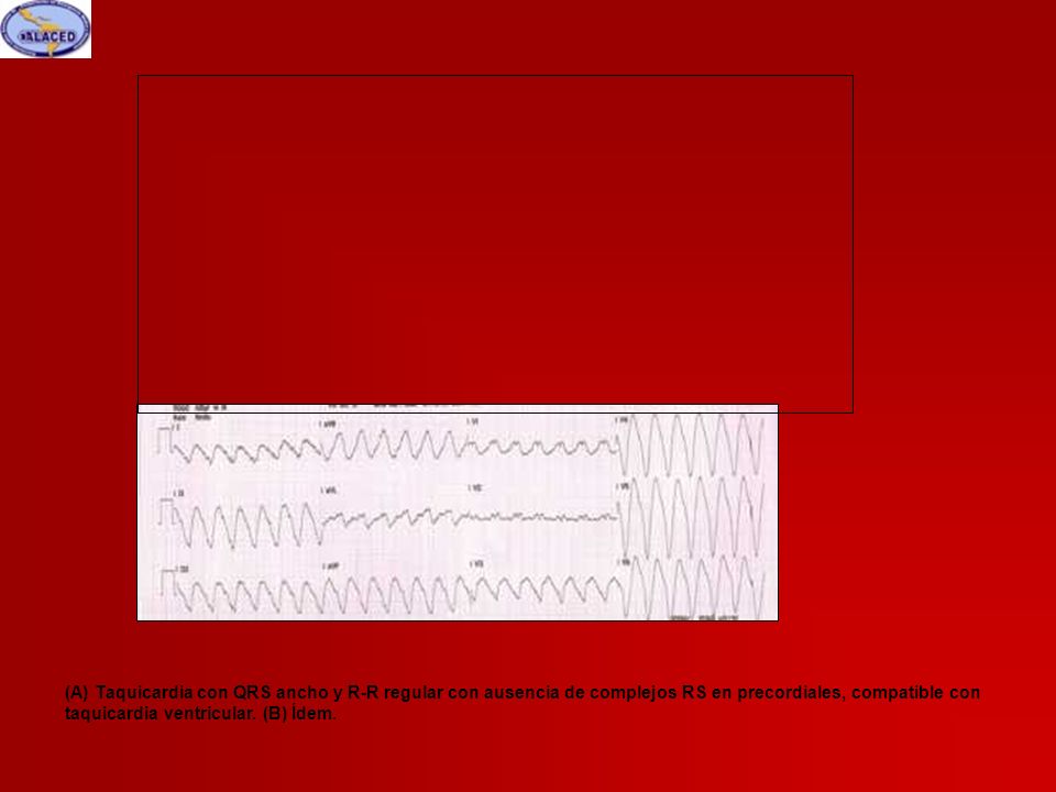 (A) Taquicardia con QRS ancho y R-R regular con ausencia de complejos RS en precordiales, compatible con taquicardia ventricular.