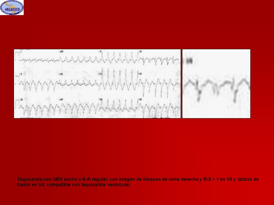 Taquicardia con QRS ancho y R-R regular, con imagen de bloqueo de rama derecha y R/S > 1 en V6 y latidos de fusión en V4, compatible con taquicardia ventricular.