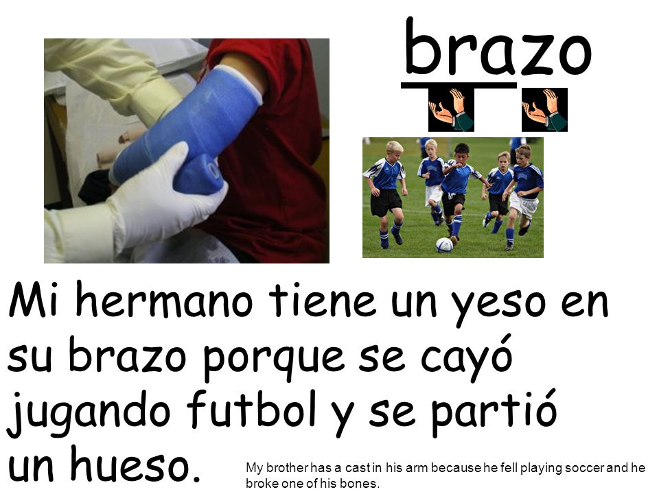 brazo Mi hermano tiene un yeso en su brazo porque se cayó