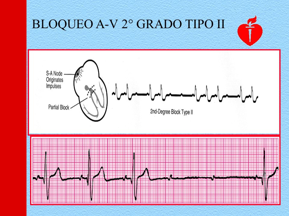 BLOQUEO A-V 2° GRADO TIPO II