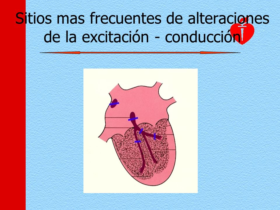 Sitios mas frecuentes de alteraciones de la excitación - conducción