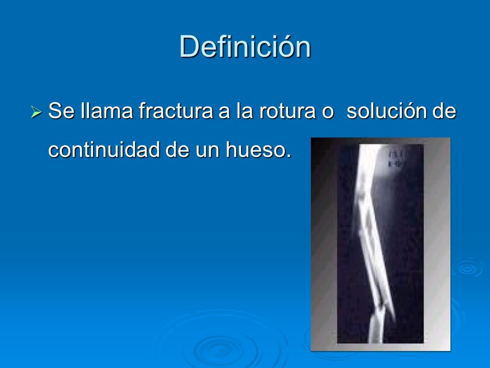 Definición Se llama fractura a la rotura o solución de continuidad de un hueso.