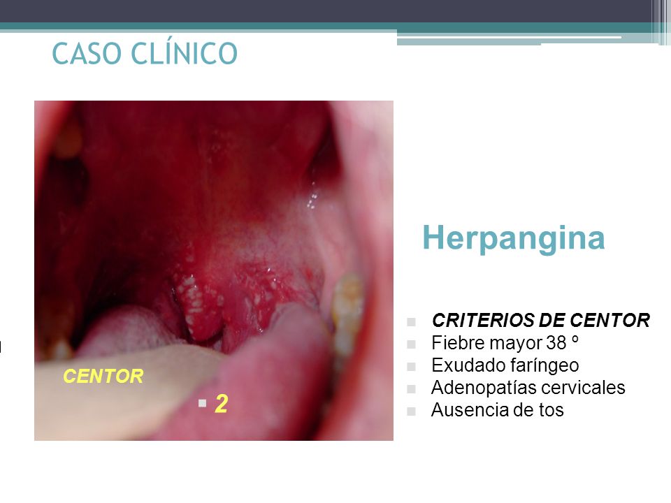 Herpangina CASO CLÍNICO 2 CRITERIOS DE CENTOR Fiebre mayor 38 º