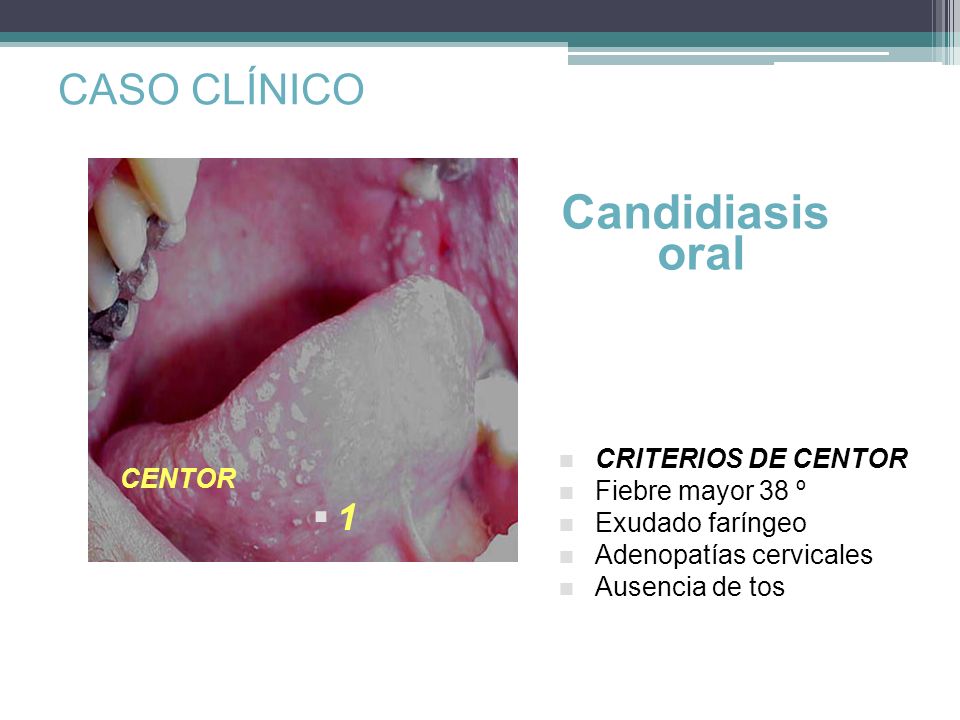Candidiasis oral CASO CLÍNICO 1 CRITERIOS DE CENTOR Fiebre mayor 38 º
