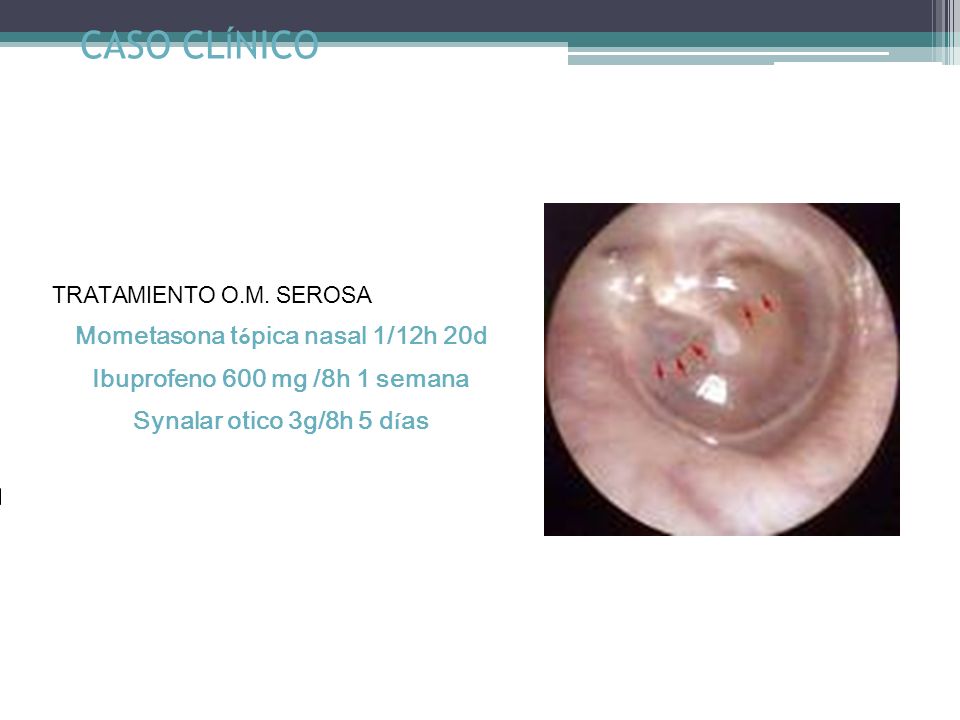 Mometasona tópica nasal 1/12h 20d Ibuprofeno 600 mg /8h 1 semana