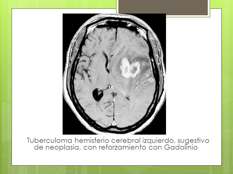Tuberculoma hemisferio cerebral izquierdo, sugestivo de neoplasia, con reforzamiento con Gadolinio