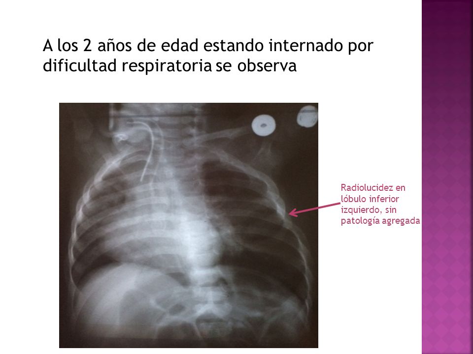 A los 2 años de edad estando internado por dificultad respiratoria se observa