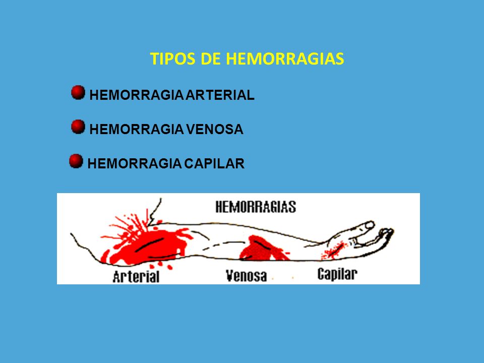 TIPOS DE HEMORRAGIAS HEMORRAGIA ARTERIAL HEMORRAGIA VENOSA