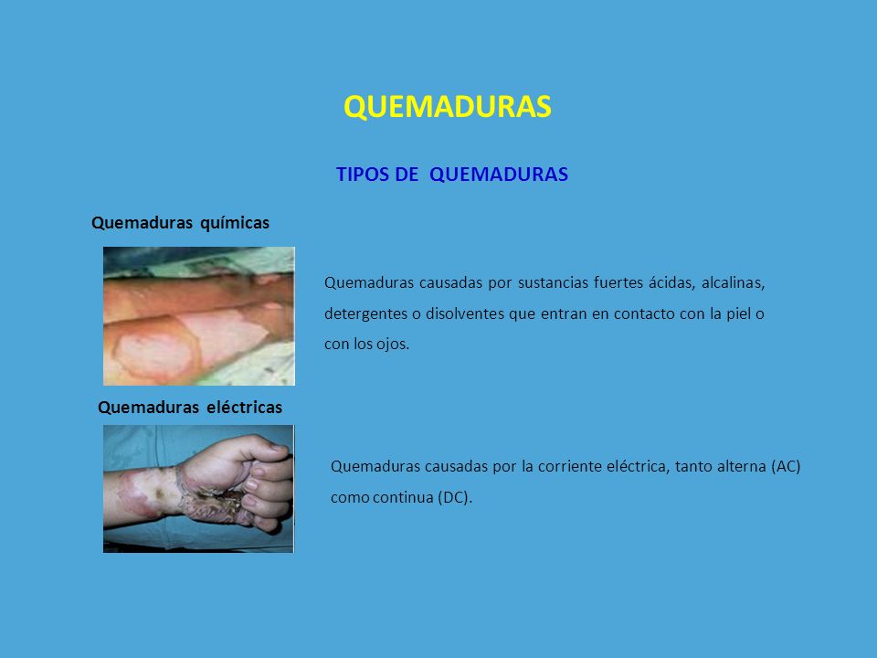 QUEMADURAS TIPOS DE QUEMADURAS Quemaduras químicas