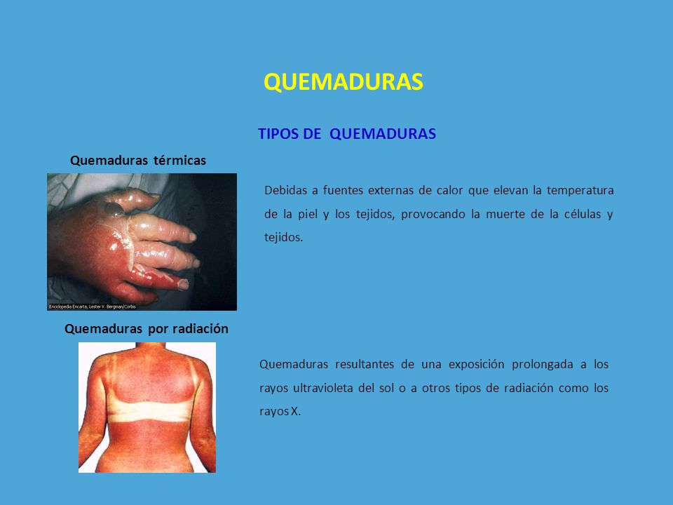 QUEMADURAS TIPOS DE QUEMADURAS Quemaduras térmicas