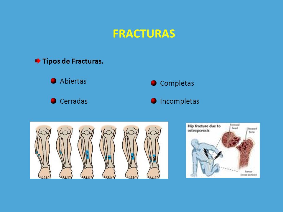 FRACTURAS Tipos de Fracturas. Abiertas Completas Cerradas Incompletas