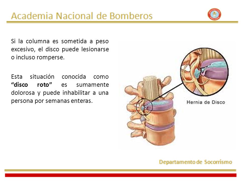Si la columna es sometida a peso excesivo, el disco puede lesionarse o incluso romperse.