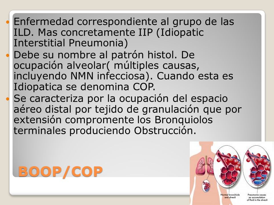 Enfermedad correspondiente al grupo de las ILD