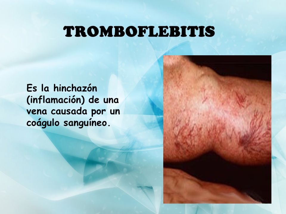 TROMBOFLEBITIS Es la hinchazón (inflamación) de una vena causada por un coágulo sanguíneo.