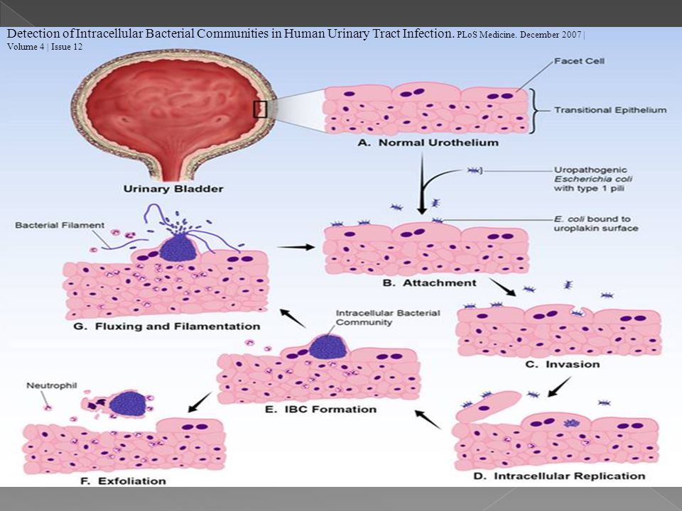 Detection of Intracellular Bacterial Communities in Human Urinary Tract Infection.